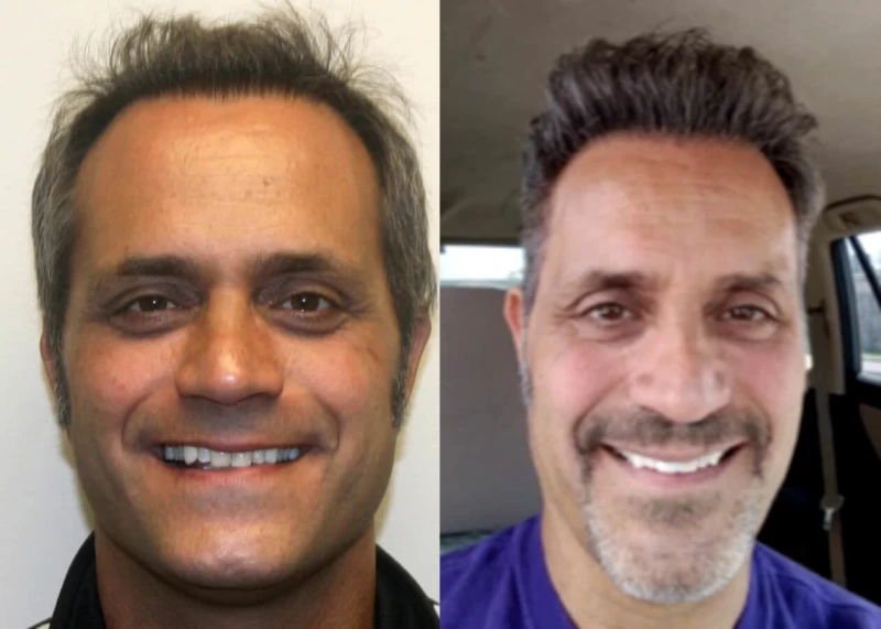 Patient 512 Hair Transplant Before and After