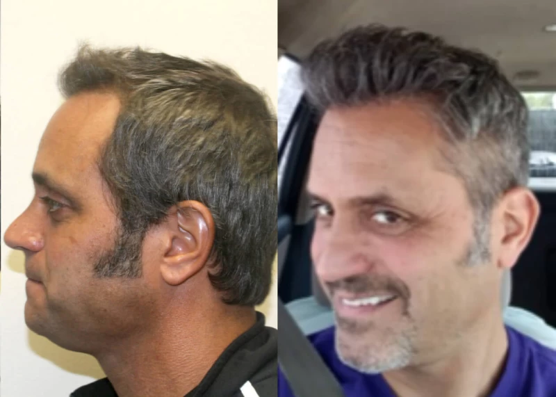 Patient p512 hair transplant before and after left view