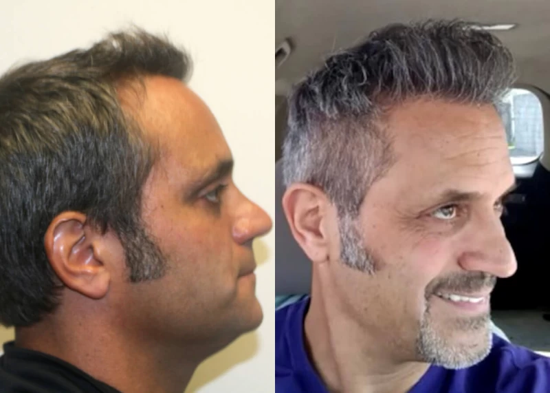 Patient p512 hair transplant before and after right view