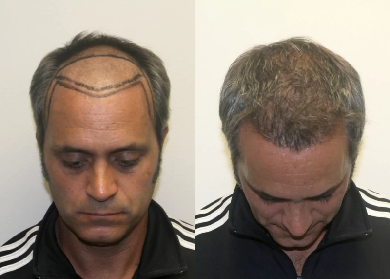 Patient p512 hair transplant before and after tilt view