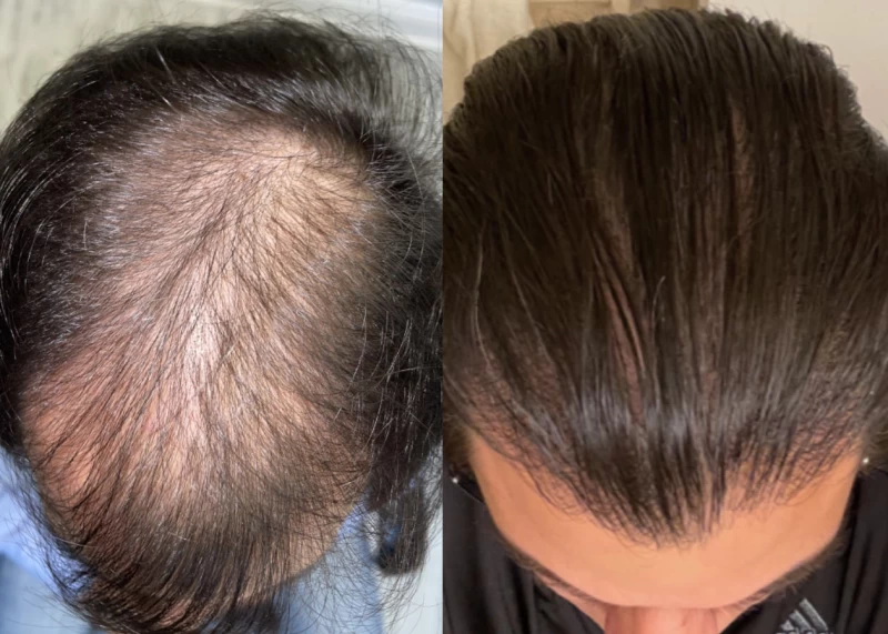 Patient 513 Hair Transplant Before and After