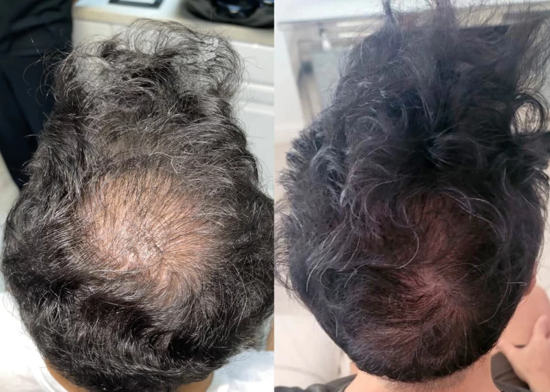 Patient p514 hair transplant before and after crown view