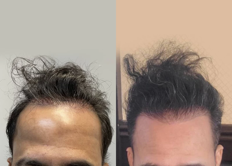 Patient 514 Hair Transplant Before and After