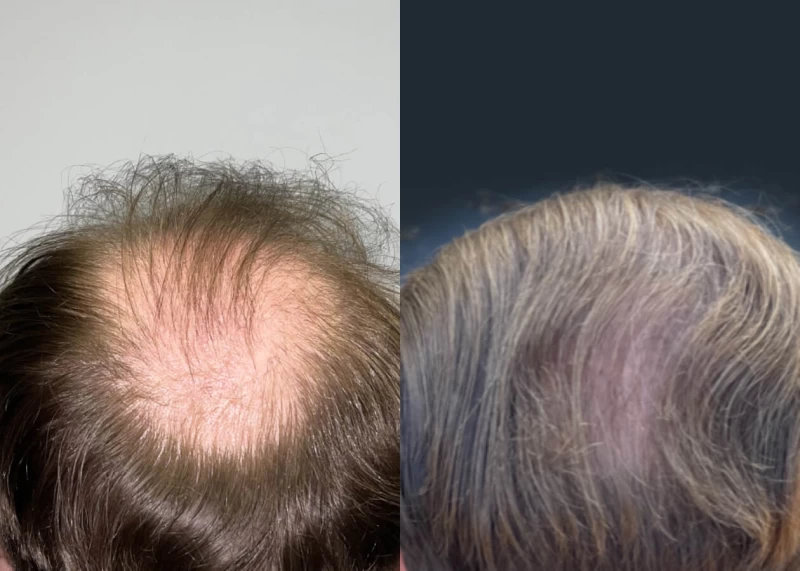 Patient p516 hair transplant before and after crown view