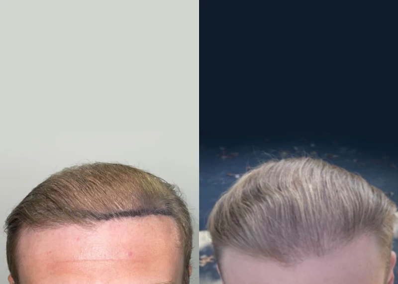 Patient 516 Hair Transplant Before and After