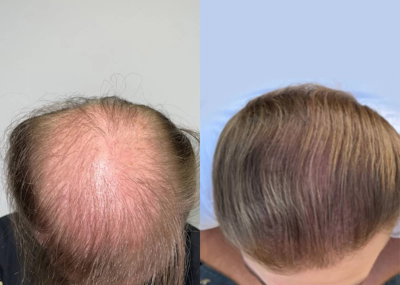 Patient p516 hair transplant before and after tilt view