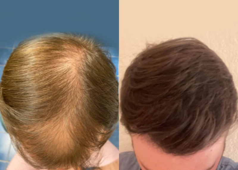 Patient 517 Hair Transplant Before and After