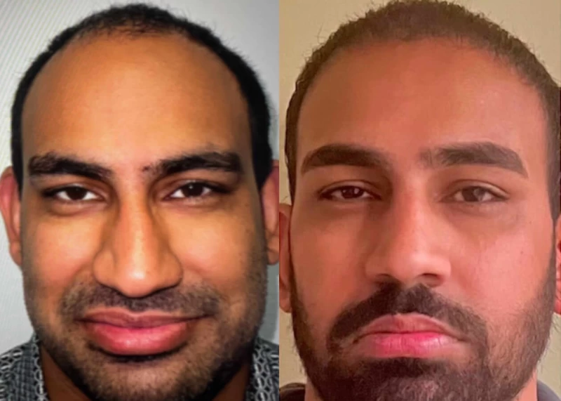 Patient 519 Hair Transplant Before and After