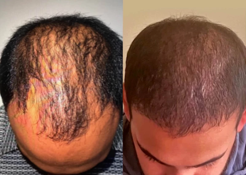 Patient p519 hair transplant before and after tilt view