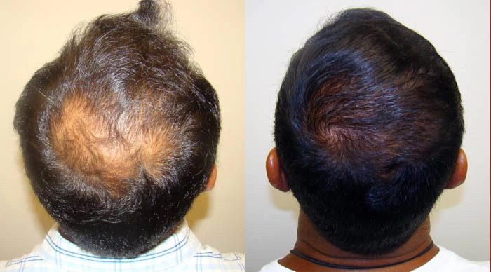 Patient p51 hair transplant before and after crown view