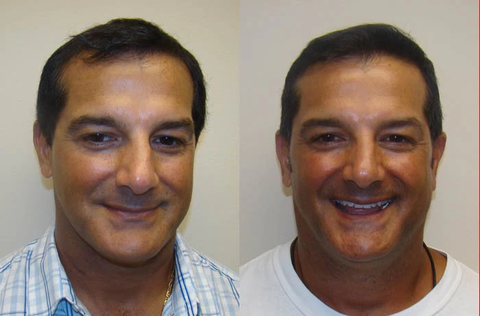 Rod Hair Transplant Before and After
