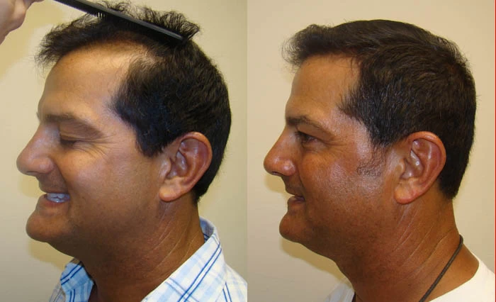 Patient p51 hair transplant before and after left view