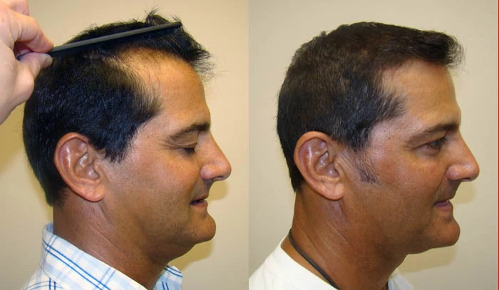 Patient p51 hair transplant before and after right view