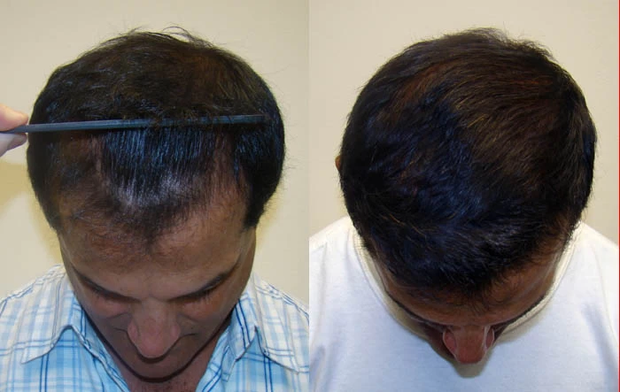 Patient p51 hair transplant before and after tilt view