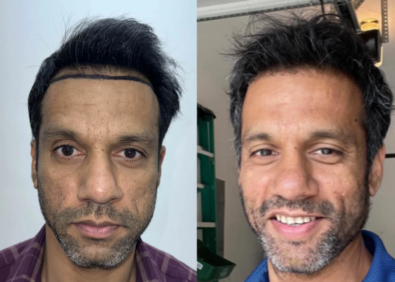 Srini Hair Transplant Before and After