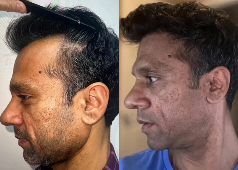 Patient p520 hair transplant before and after left view