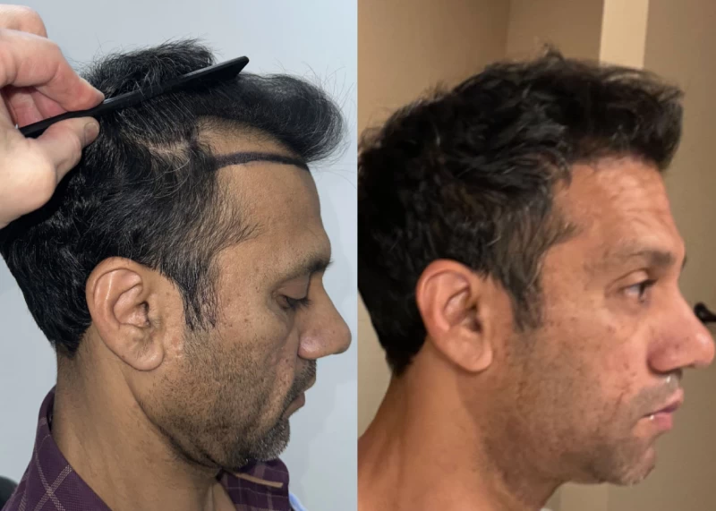 Patient p520 hair transplant before and after right view