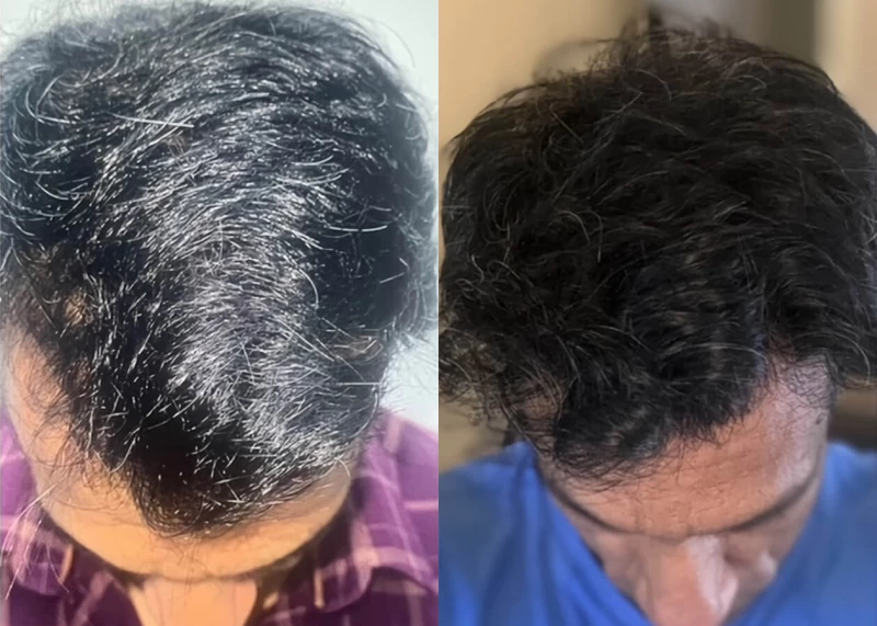 Patient p520 hair transplant before and after tilt view