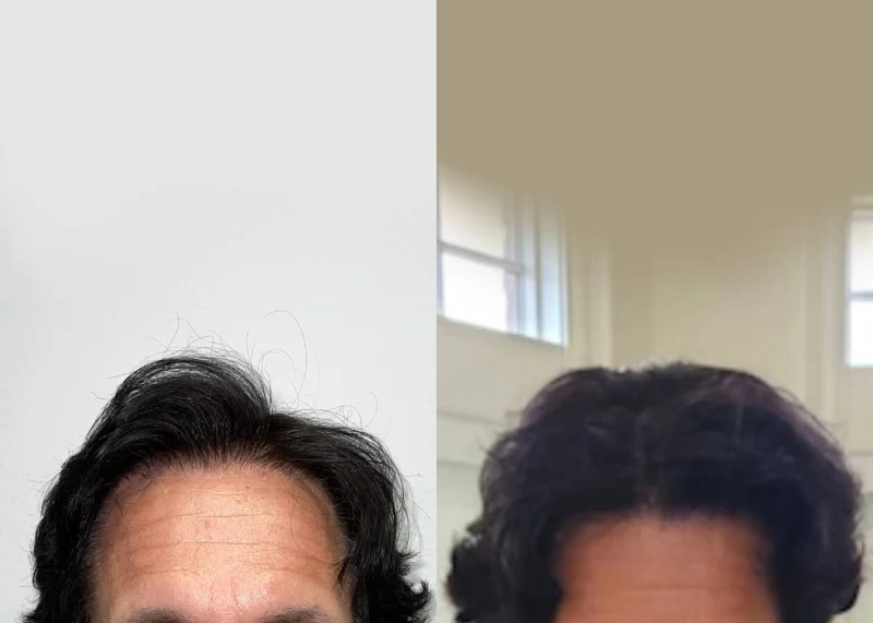 Patient 521 Hair Transplant Before and After