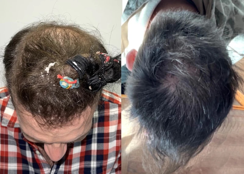 Patient 522 Hair Transplant Before and After