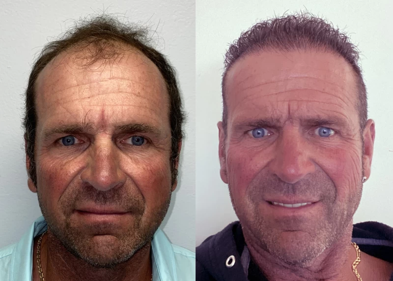 Patient 523 Hair Transplant Before and After