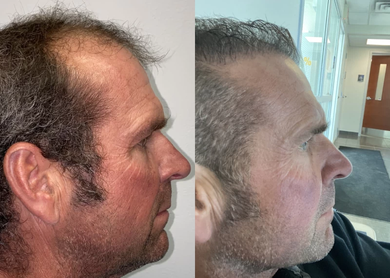 Patient p523 hair transplant before and after right view