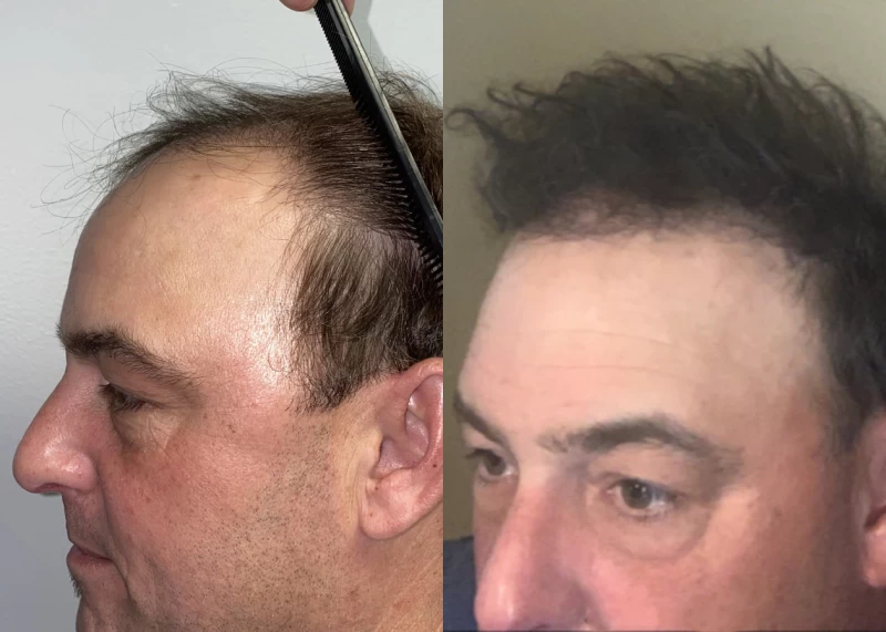 Patient p524 hair transplant before and after left view
