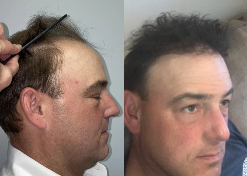 Patient p524 hair transplant before and after right view