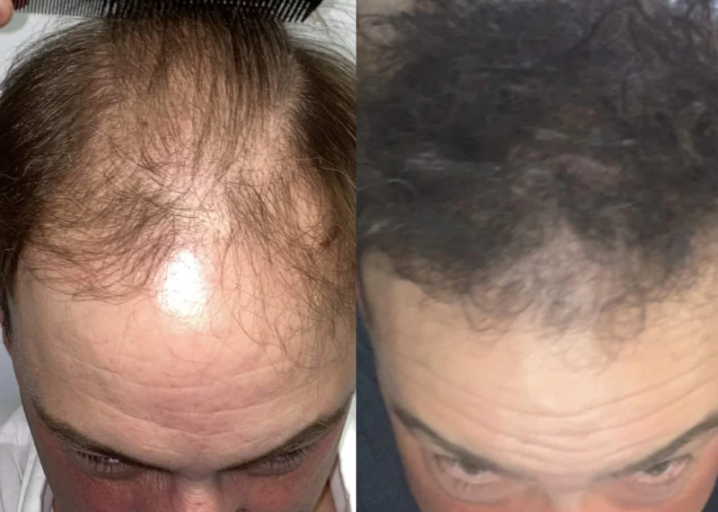Patient 524 Hair Transplant Before and After