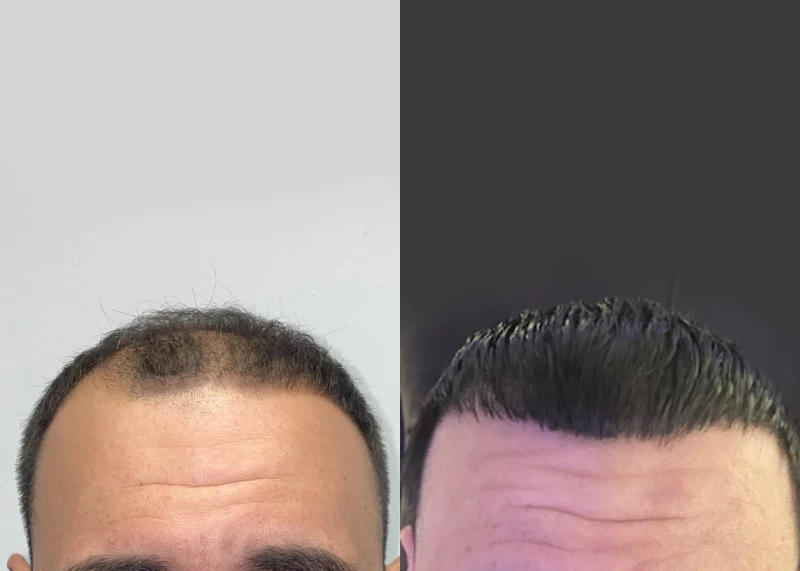Patient 525 Hair Transplant Before and After