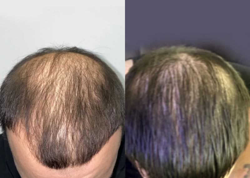 Patient p525 hair transplant before and after tilt view