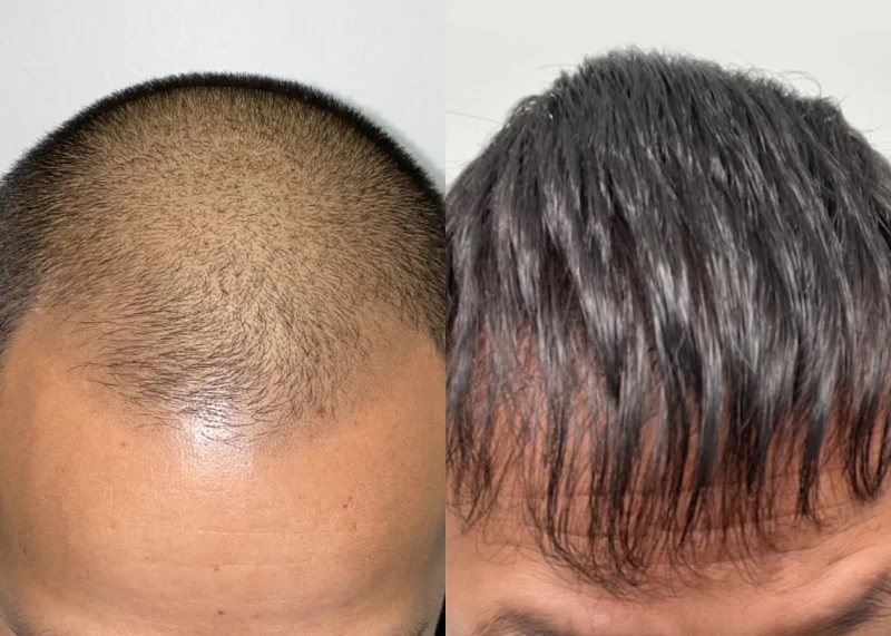 Patient 526 Hair Transplant Before and After