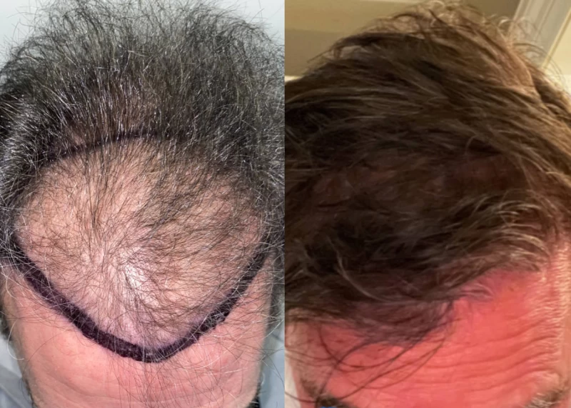 Patient 527 Hair Transplant Before and After