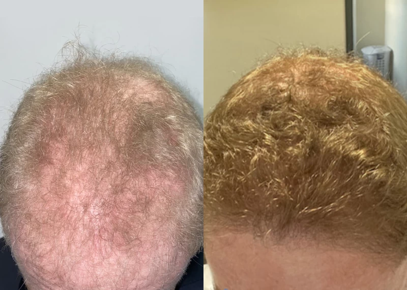 Patient 528 Hair Transplant Before and After