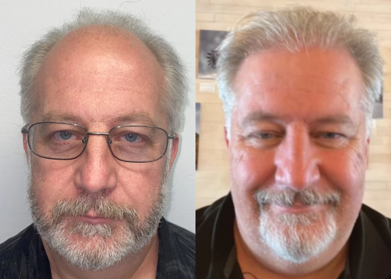Patient 529 Hair Transplant Before and After