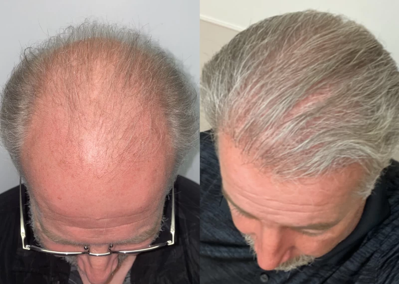Patient p529 hair transplant before and after tilt view