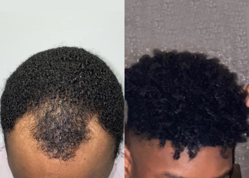 Patient 530 Hair Transplant Before and After