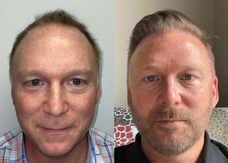 Patient 531 Hair Transplant Before and After