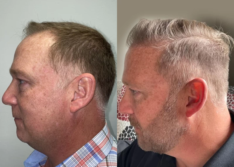 Patient p531 hair transplant before and after left view