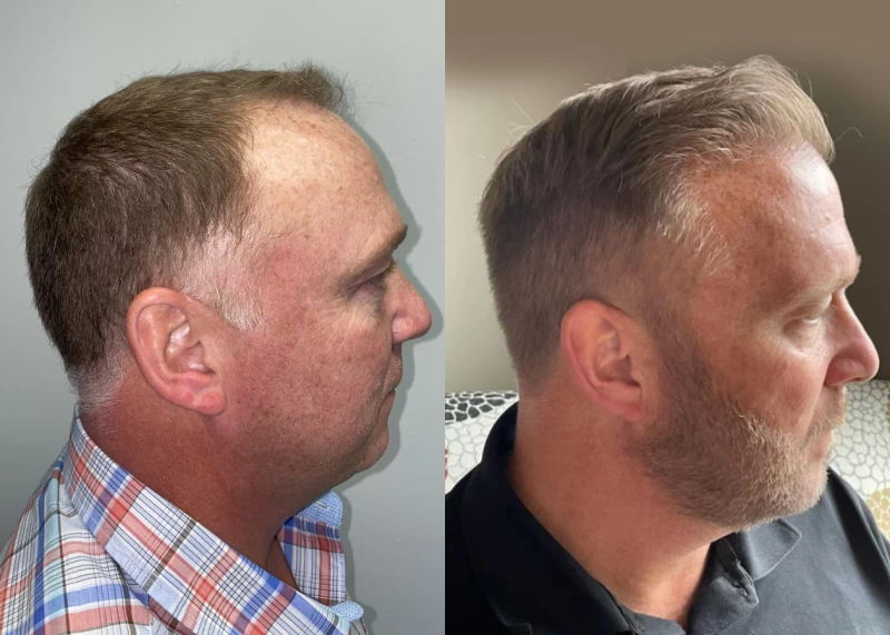 Patient p531 hair transplant before and after right view