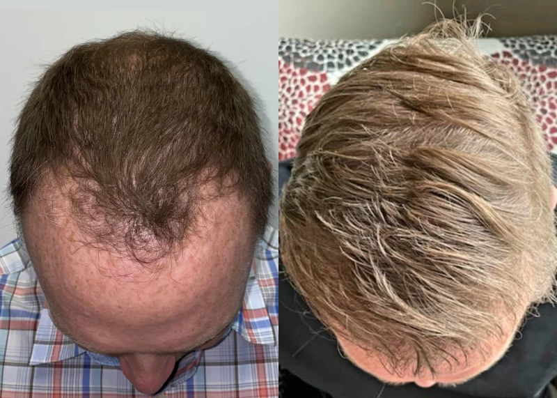 Patient p531 hair transplant before and after tilt view