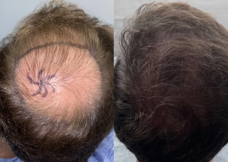 Patient p532 hair transplant before and after crown view