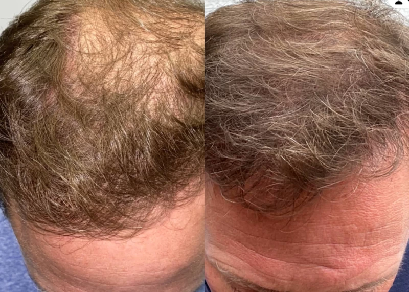 Patient 532 Hair Transplant Before and After