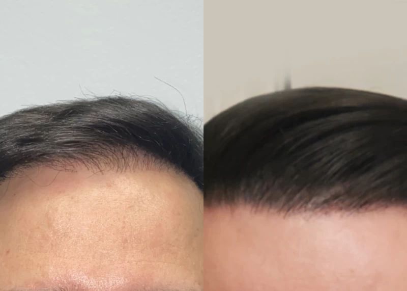 Patient 534 Hair Transplant Before and After