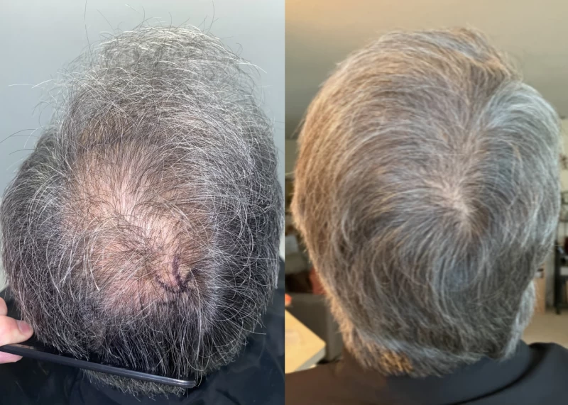 Patient p535 hair transplant before and after crown view