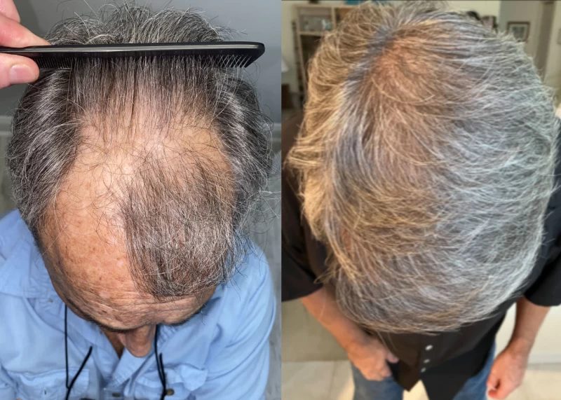 Patient 535 Hair Transplant Before and After