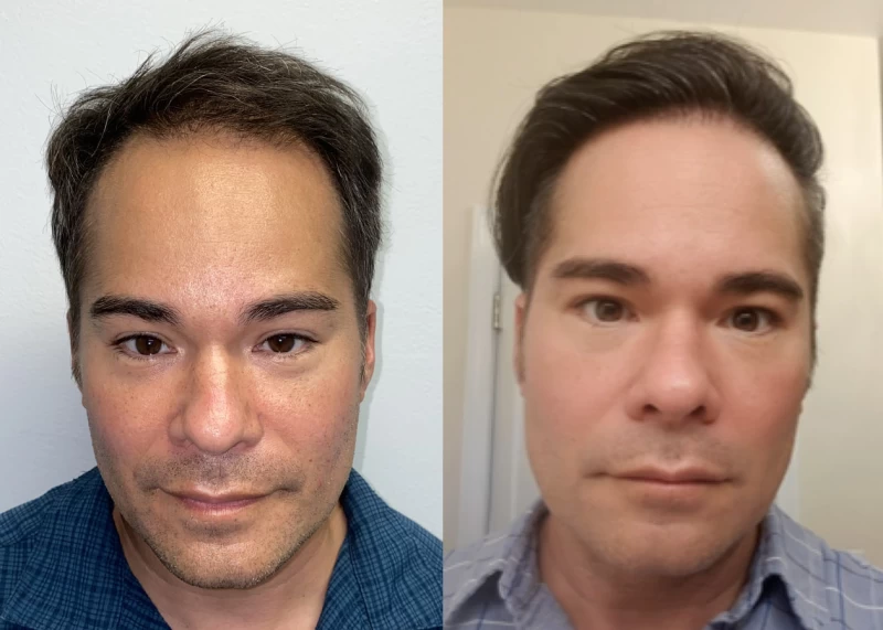Patient 536 Hair Transplant Before and After