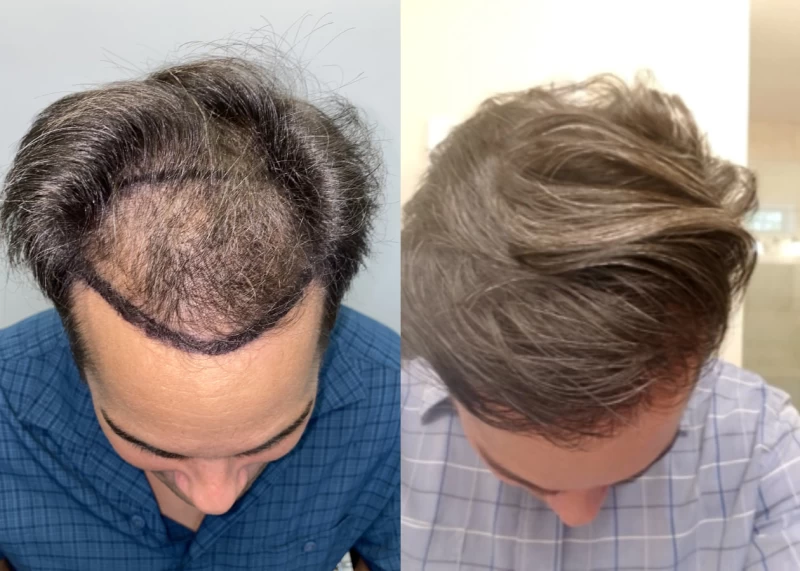 Patient p536 hair transplant before and after tilt view