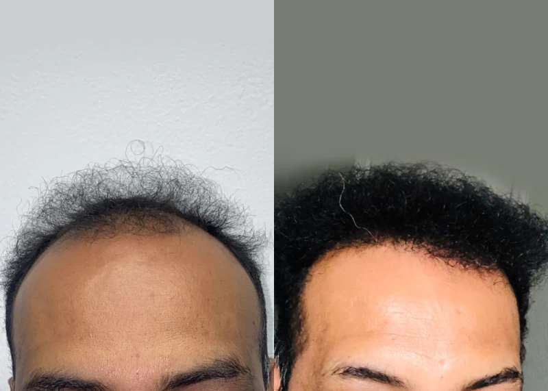 Patient 537 Hair Transplant Before and After