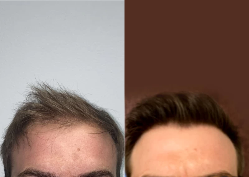 Patient 538 Hair Transplant Before and After